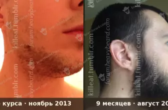 Борода до курса миноксидила и через 9 месяцев: сравнение фото